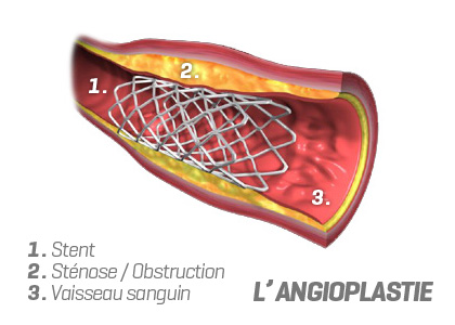 angioplastie